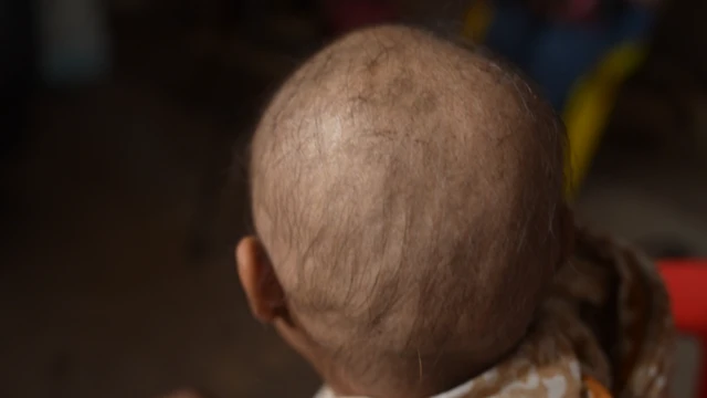sudden hair loss has caused social problems for some villagers.