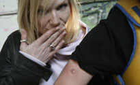Jo with Scott's bruises